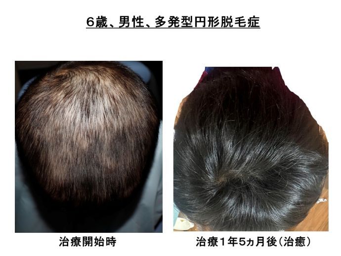 円形脱毛症　病院